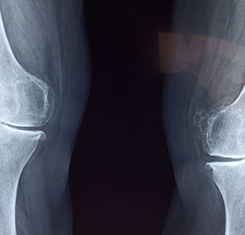 Researchers find method to regrow cartilage in the joints