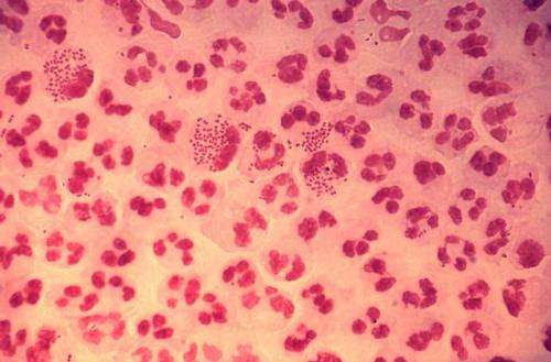 Test accurately IDs people whose gonorrhea can be cured with simple oral antibiotic