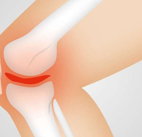 New approach to treating osteoarthritis advances