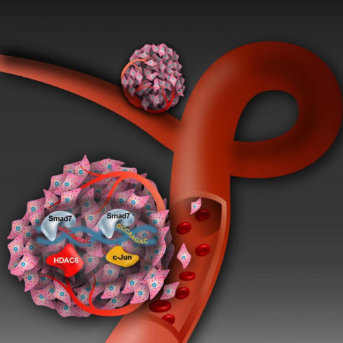 Novel insights of how prostate cancer causes secondary tumors