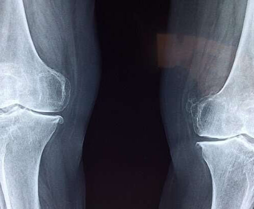 New molecule repairs cartilage and relieves symptoms of osteoarthritis