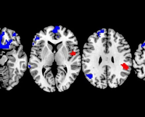 Which OCD Treatment Works Best? New Brain Study Could Lead to More Personalized Choices