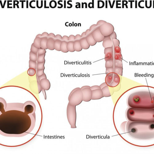 Everything you need to know about diverticulitis