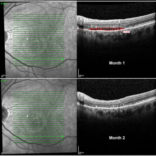 Levodopa may improve vision in patients with macular degeneration