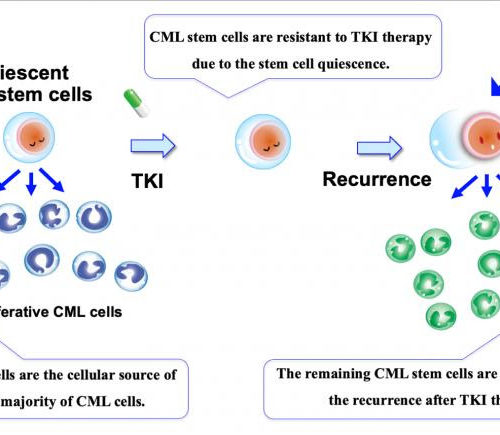 New way to halt leukemia relapse shown promising in mice