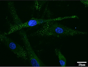 Immune Protein IL-17A Responsible for Lethal Side Effects of Gastric Cancer