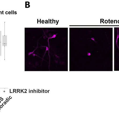 Parkinson’s patient skin samples provide clues to disease mechanism and a possible clinical test