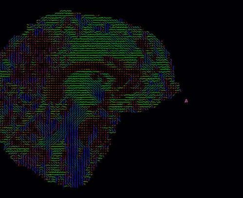 Preserving Brain Tissue with Stem Cells