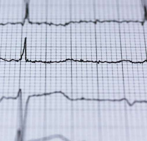 Research pinpoints sources of atrial fibrillation