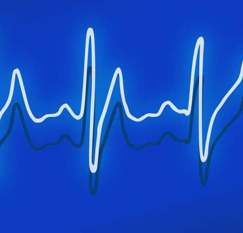 Concealed cardiomyopathies revealed in cardiac arrest survivors