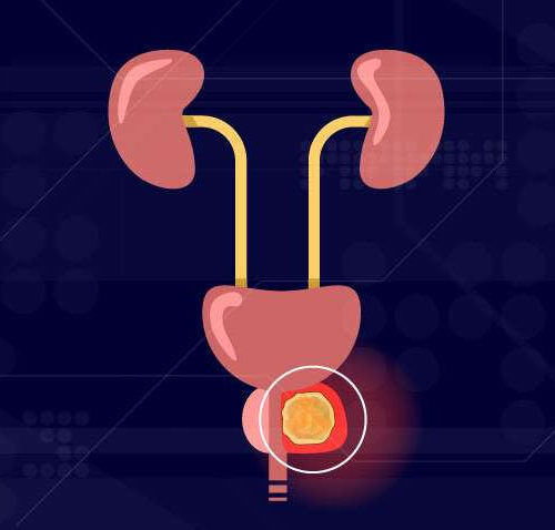 Toward a new staging system for prostate cancer, and why it matters