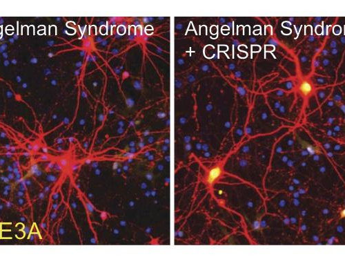 Scientists take major step toward Angelman Syndrome gene therapy