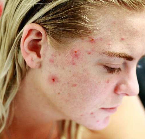 Researchers find that patients with acne have reduced expression of the protein GATA6