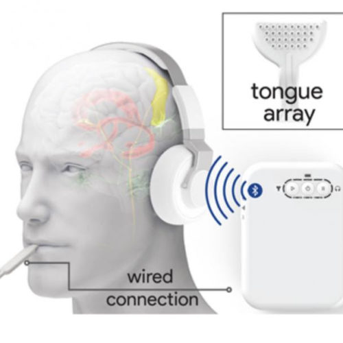 Sensory device stimulates ears and tongue to treat tinnitus in large trial