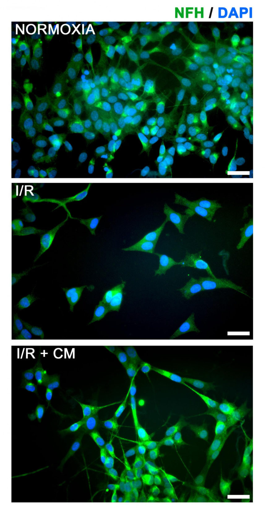 Amniotic fluid may yield new, better treatment for ischemic stroke