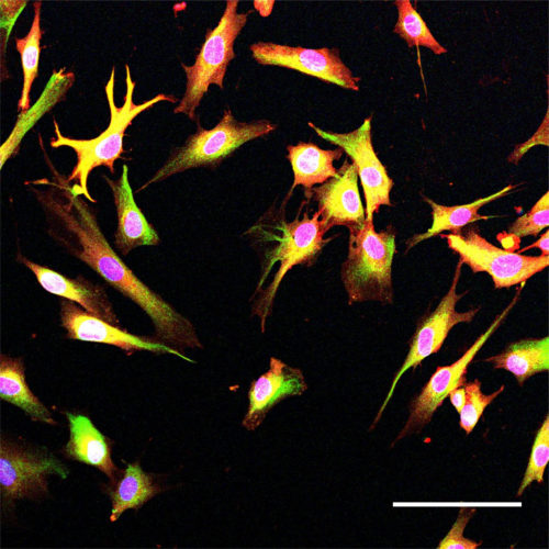 Alzheimer’s risk gene disrupts endocytosis, but another disease-linked gene could help