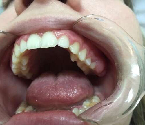 Pathogens in the mouth induce oral cancer