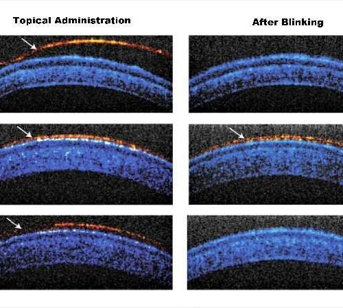 Temperature-sensitive, longer-lasting eyedrops may mean fewer applications, better therapy