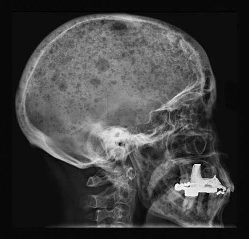 Perforated bone tissue from too little sugar