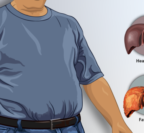 Non-Alcoholic Fatty Liver Disease as the Marker of a Lifestyle that Shortens Life Span