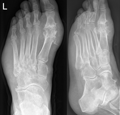 FAST study finds no increased risk of cardiovascular events with febuxostat as compared with allopurinol for gout