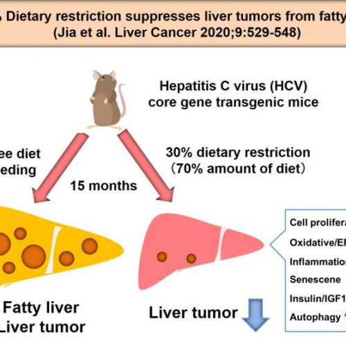 Eating less suppresses liver cancer due to fatty liver