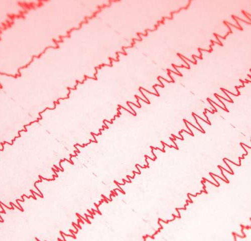 What EEGs tell us about COVID-19 and the brain