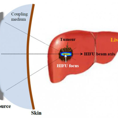 Destroying cancer cells with non-surgical ultrasound treatment