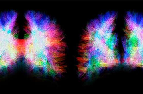 A malformation illustrates the incredible plasticity of the brain