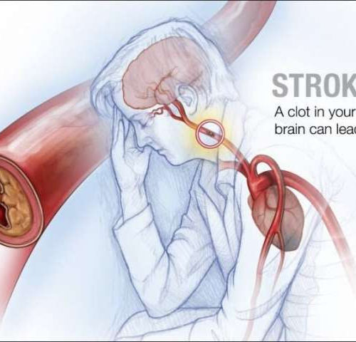 Protein in blood may predict prognosis, recovery from stroke