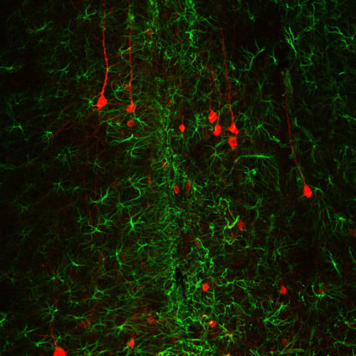 Reversal of glial scar tissue back to neuronal tissue through neuroregenerative gene therapy