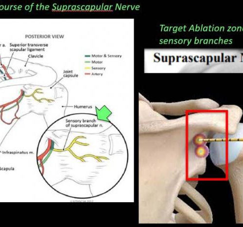 Novel technique ‘stuns’ arthritis pain in shoulder and hip