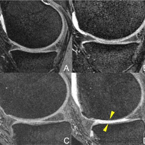 Racket sports may worsen knee arthritis