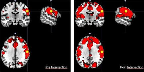 Virtual reality applied to rehabilitation for stroke and neurodegenerative disease patients