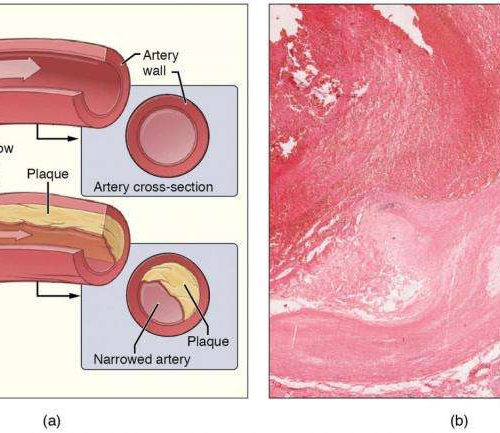 Protein regulating inflammation in atherosclerosis identified