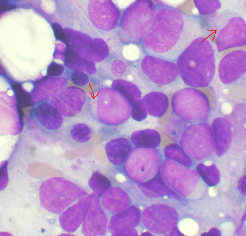 Global trial reveals life saving drug for acute myeloid leukemia