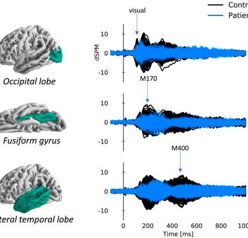 Emerging from the fog: Little understood post-stroke cognitive issues are verified