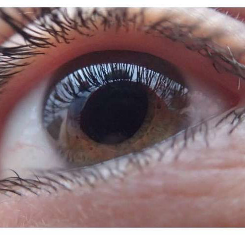 Hopes of new treatment strategies for glaucoma