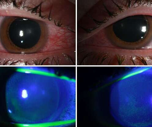 COVID’s collateral damage: Germicidal lamps may damage corneas