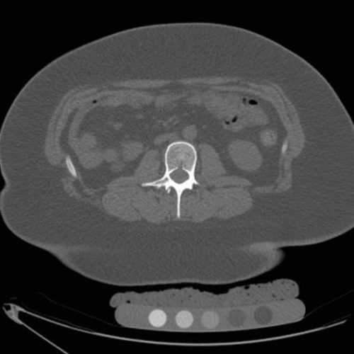 Popular weight-loss surgery in teenagers weakens bones