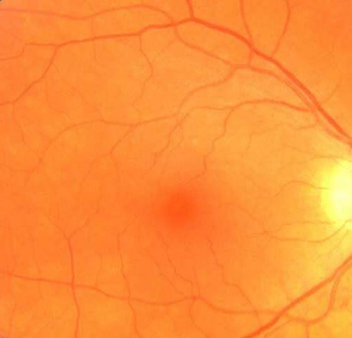 Eye exam could lead to early Parkinson’s disease diagnosis