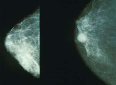 New mammogram measures of breast cancer risk could revolutionise screening