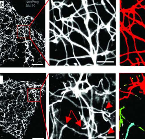 Protein commonly screened for in pregnancy is linked to gestational diabetes