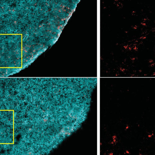 Harvard study finds fatty diets may feed cancer and starve immune cells