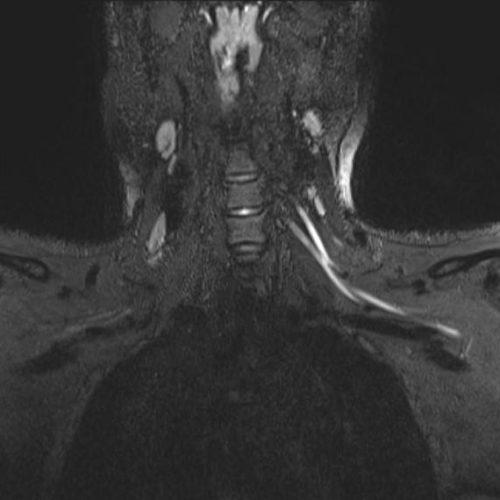 Post-COVID pain or weakness? Request an ultrasound or MRI