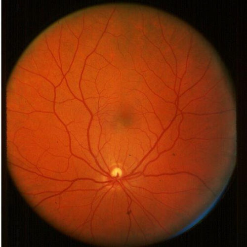 Routine eye scans may give clues to cognitive decline in diabetes