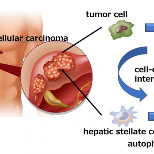 Liver cancer cells manipulate stromal cells involved in fibrosis to promote tumor growth