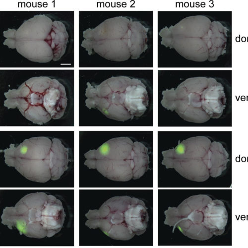 Researchers link cellular transport pathway to aggressive brain cancer