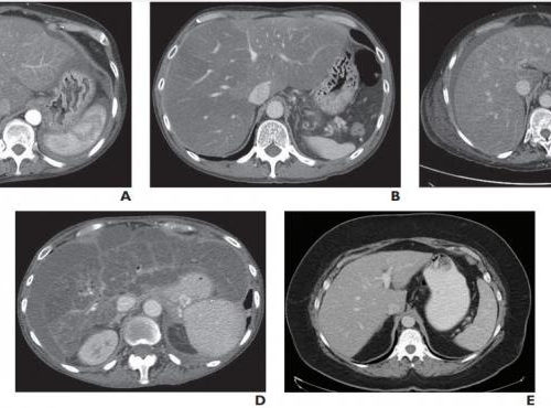 CT identifies patients with high-risk nonalcoholic fatty liver disease (NAFLD)