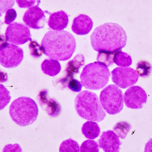 New maintenance treatment for acute myeloid leukemia prolongs the lives of patients